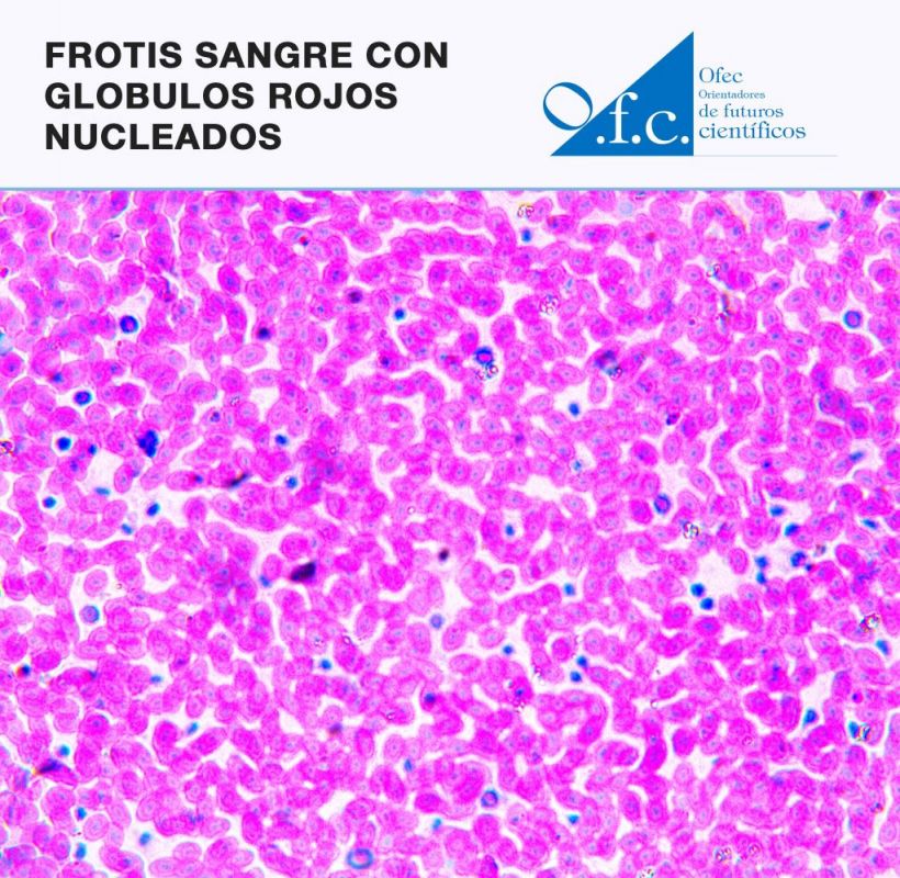 Frotis sangre con glóbulos rojos nucleados