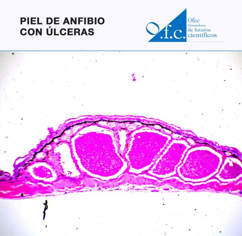 Piel de anfibio con úlceras