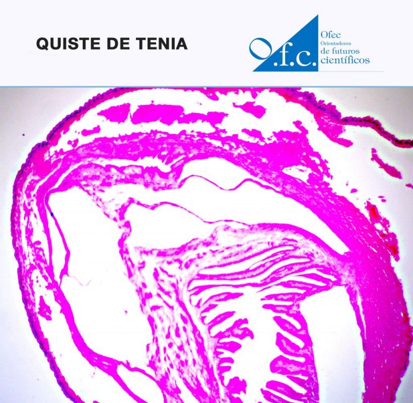 Quiste de tenia