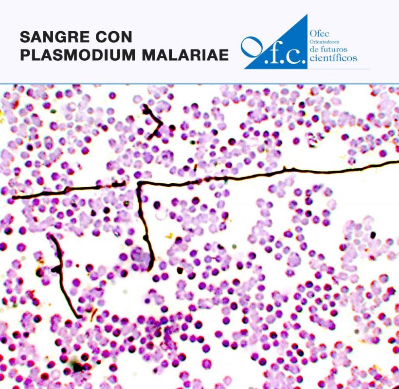 Sangre con plasmodium malariae